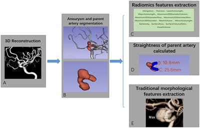 Morphological features predicting in-stent stenosis after pipeline implantation for unruptured intracranial aneurysm